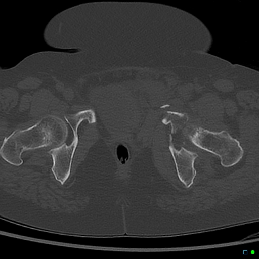 Central fracture-dislocation of the acetabulum (Radiopaedia 36578-38150 Axial bone window 71).jpg