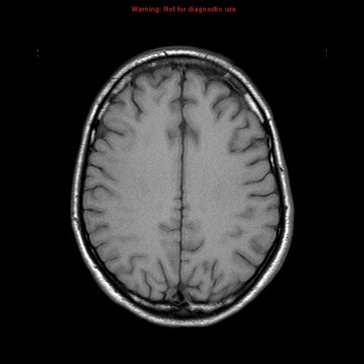 File:Central nervous system vasculitis (Radiopaedia 8410-9235 Axial T1 17).jpg
