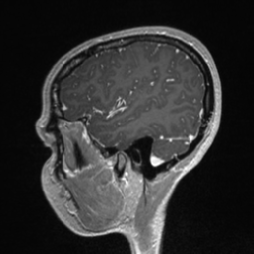 Central neurocytoma (Radiopaedia 37664-39557 Sagittal T1 C+ 77).png