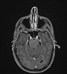 Central neurocytoma (Radiopaedia 84497-99872 Axial T1 C+ 49).jpg