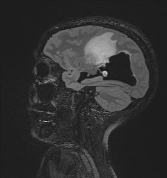 Central neurocytoma (Radiopaedia 84497-99872 Sagittal Flair + Gd 105).jpg