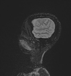 Central neurocytoma (Radiopaedia 84497-99872 Sagittal Flair + Gd 26).jpg