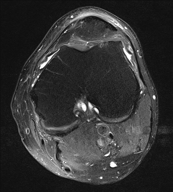 File:Central osteophyte (Radiopaedia 72592-83150 Axial PD fat sat 14).jpg