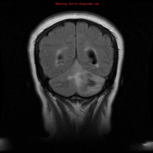 File:Cerebellar abscess (Radiopaedia 10845-11275 Coronal FLAIR 1).jpg