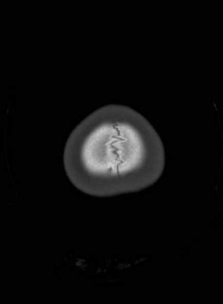 Cerebellar abscess (Radiopaedia 73727-84527 Axial bone window 63).jpg