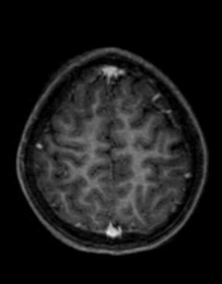 Cerebellar abscess (Radiopaedia 73727-84563 Axial T1 C+ fat sat 90).jpg