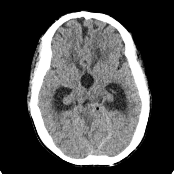 Cerebellar abscess secondary to mastoiditis (Radiopaedia 26284-26412 Axial non-contrast 63).jpg