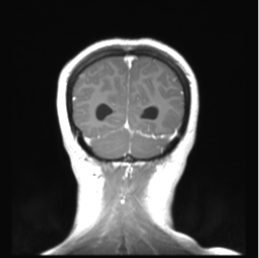 File:Cerebellar ependymoma complicated by post-operative subdural hematoma (Radiopaedia 83322-97736 Coronal T1 C+ 49).png