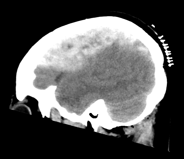 File:Cerebellar ependymoma complicated by post-operative subdural hematoma (Radiopaedia 83322-97737 C 8).png