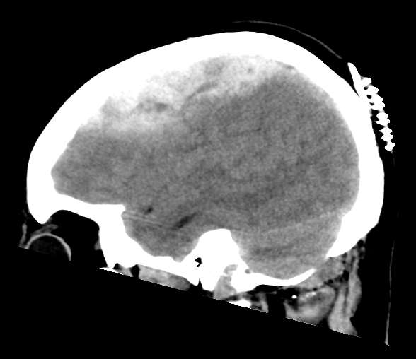 File:Cerebellar ependymoma complicated by post-operative subdural hematoma (Radiopaedia 83322-97737 C 9).png
