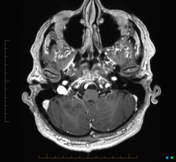 Cerebellar gangliocytoma (Radiopaedia 65377-74422 Axial T1 C+ 15).jpg