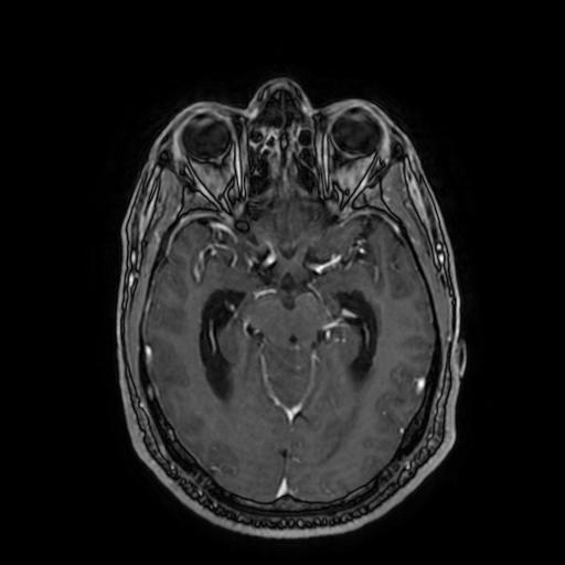 Cerebellar hemangioblastoma (Radiopaedia 88055-104622 Axial T1 C+ 81).jpg