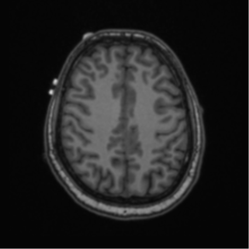 Cerebellar hemangioblastomas and pituitary adenoma (Radiopaedia 85490-101176 Axial T1 53).png