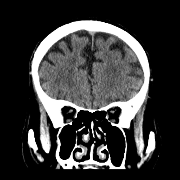 Cerebellar hemorrhage (Radiopaedia 27193-27359 Coronal non-contrast 17).jpg