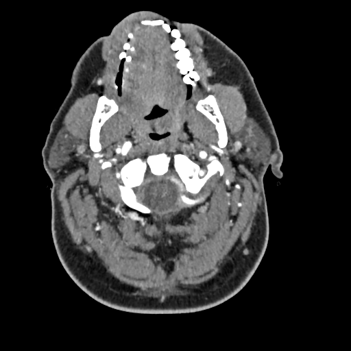 Cerebellar infarct due to vertebral artery dissection with posterior fossa decompression (Radiopaedia 82779-97029 C 64).png