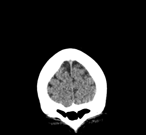 File:Cerebellar metastases - colorectal adenocarcinoma (Radiopaedia 40947-43652 Coronal non-contrast 14).png