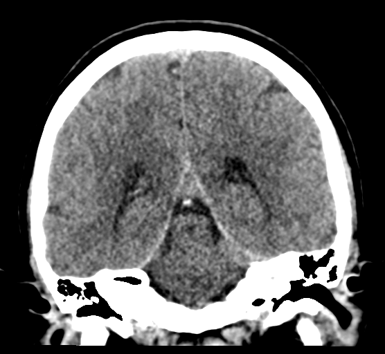 Cerebellar metastases - colorectal adenocarcinoma (Radiopaedia 40947-43652 Coronal non-contrast 60).png