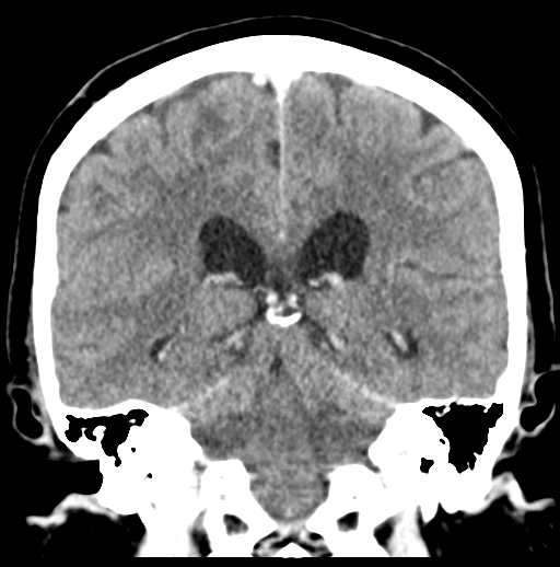 Cerebellar metastasis (Radiopaedia 54578-60812 Coronal C+ 36).png