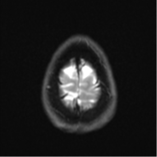 Cerebellar metastasis - adenocarcinoma lung (Radiopaedia 63184-71715 Axial DWI 28).png
