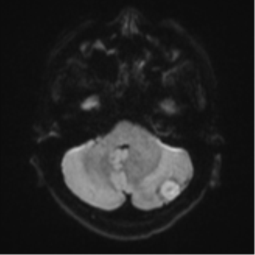 Cerebellar metastasis - adenocarcinoma lung (Radiopaedia 63184-71715 Axial DWI 35).png