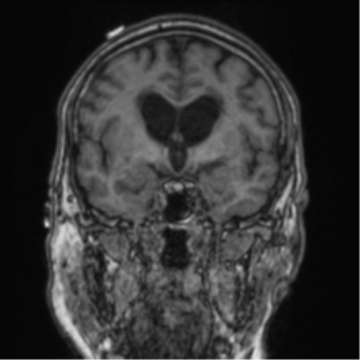 Cerebellar metastasis from lung adenocarcinoma (Radiopaedia 86690-102829 Coronal T1 60).png