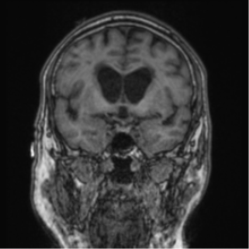 Cerebellar metastasis from lung adenocarcinoma (Radiopaedia 86690-102829 Coronal T1 62).png