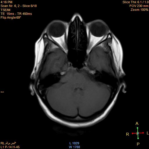 File:Cerebellopontine angle meningioma (Radiopaedia 22488-22525 Axial T1 4).jpg