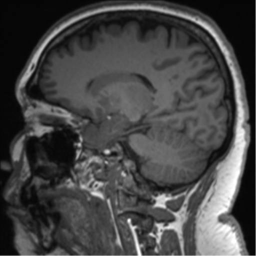 Cerebellopontine angle meningioma (Radiopaedia 48434-53348 Sagittal T1 55).png