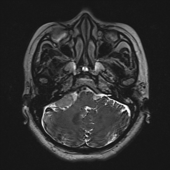 Cerebellopontine angle meningioma (Radiopaedia 53561-59591 Axial 3D volume T2 46).jpg