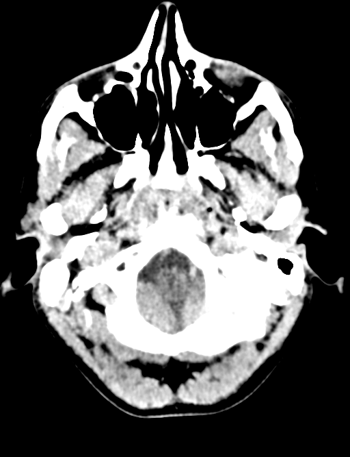Cerebral abscess (Radiopaedia 60342-68008 Axial non-contrast 7).png