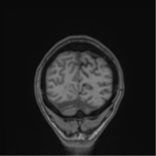 Cerebral abscess (Radiopaedia 60342-68009 Coronal T1 1).png