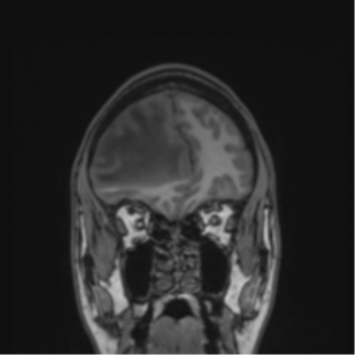Cerebral abscess (Radiopaedia 60342-68009 Coronal T1 43).png