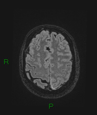 Cerebral abscess and subdural empyema (Radiopaedia 84436-99779 Axial FLAIR 23).jpg