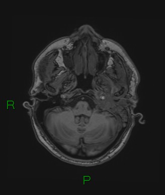 Cerebral abscess and subdural empyema (Radiopaedia 84436-99779 Axial T1 68).jpg
