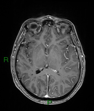 File:Cerebral abscess and subdural empyema (Radiopaedia 84436-99779 Axial T1 C+ 42).jpg
