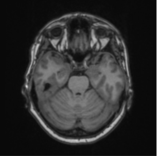 Cerebral abscess from pulmonary arteriovenous malformation (Radiopaedia 86275-102291 Axial T1 27).png