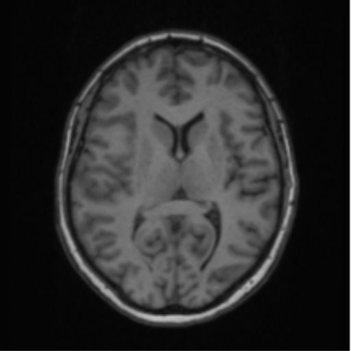 Cerebral abscess from pulmonary arteriovenous malformation (Radiopaedia 86275-102291 Axial T1 41).png