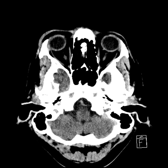 File:Cerebral abscess with ventriculitis (Radiopaedia 78965-91877 A 9).jpg