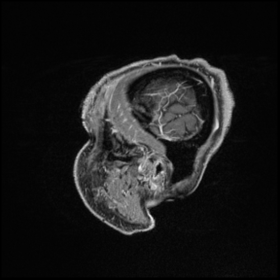 Cerebral abscess with ventriculitis (Radiopaedia 78965-91878 Sagittal T1 C+ 20).jpg