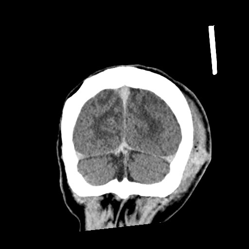 Cerebral amyloid angiopathy-related inflammation (Radiopaedia 74836-85848 Coronal non-contrast 63).jpg