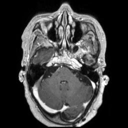 Cerebral amyloid angiopathy (Radiopaedia 29129-29518 Axial T1 C+ 41).jpg