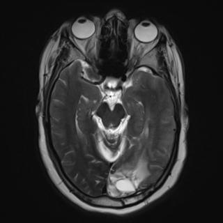 File:Cerebral amyloid angiopathy (Radiopaedia 29129-29518 Axial T2 8).jpg