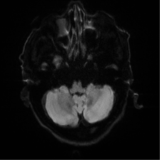 Cerebral amyloid angiopathy (Radiopaedia 46082-50433 Axial DWI 32).png
