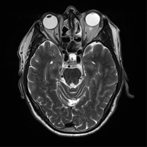 File:Cerebral amyloid angiopathy (Radiopaedia 46082-50433 Axial T2 13).png