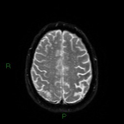 Cerebral amyloid angiopathy (Radiopaedia 77506-89664 Axial DWI 50).jpg