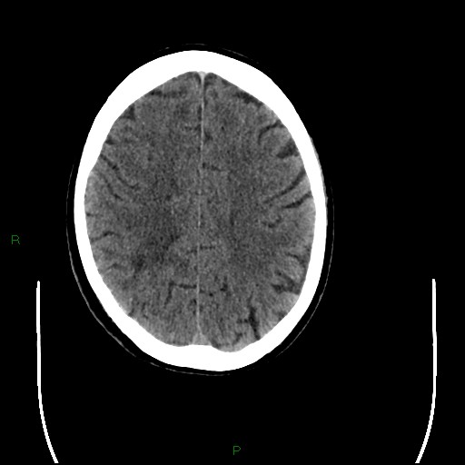 Cerebral amyloid angiopathy (Radiopaedia 77506-89665 Axial non-contrast 77).jpg