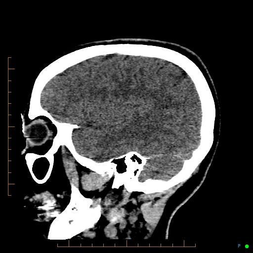 Cerebral arteriovenous malformation (AVM) (Radiopaedia 78162-90706 A 59).jpg