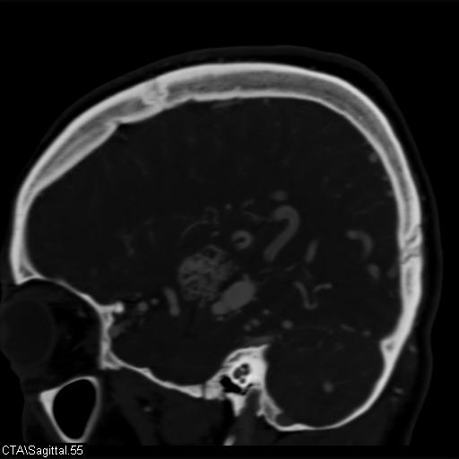 File:Cerebral arteriovenous malformation (Radiopaedia 28518-28759 D 52).jpg