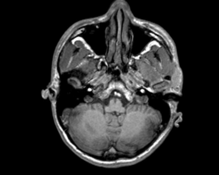 Cerebral arteriovenous malformation (Radiopaedia 30198-30813 Axial T1 46).jpg