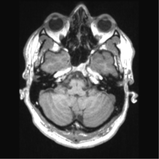 File:Cerebral arteriovenous malformation (Radiopaedia 39259-41506 Axial T1 18).png